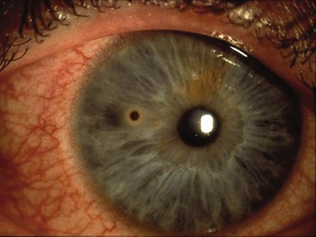 Ophthalmology Anesthesia Key