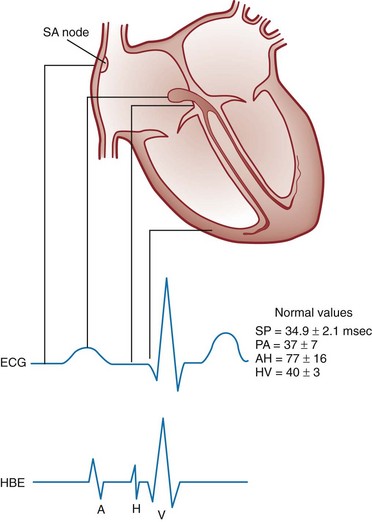 Dysrhythmias | Anesthesia Key