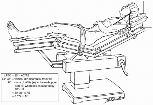 Complications Of The Beach Chair Position Anesthesia Key