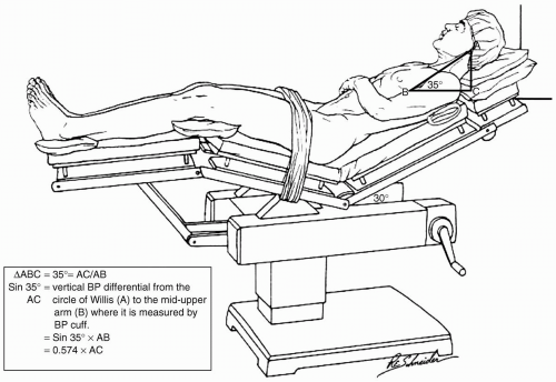 Complications of The Beach Chair Position Anesthesia Key