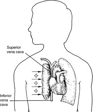 17. Thoracic Trauma | Anesthesia Key