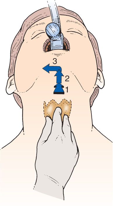 Trauma Airway Management | Anesthesia Key