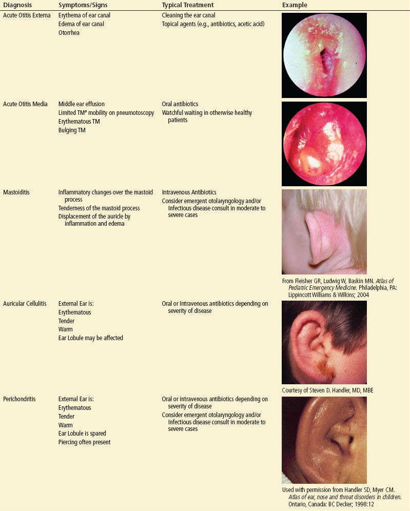 mastoiditis symptoms