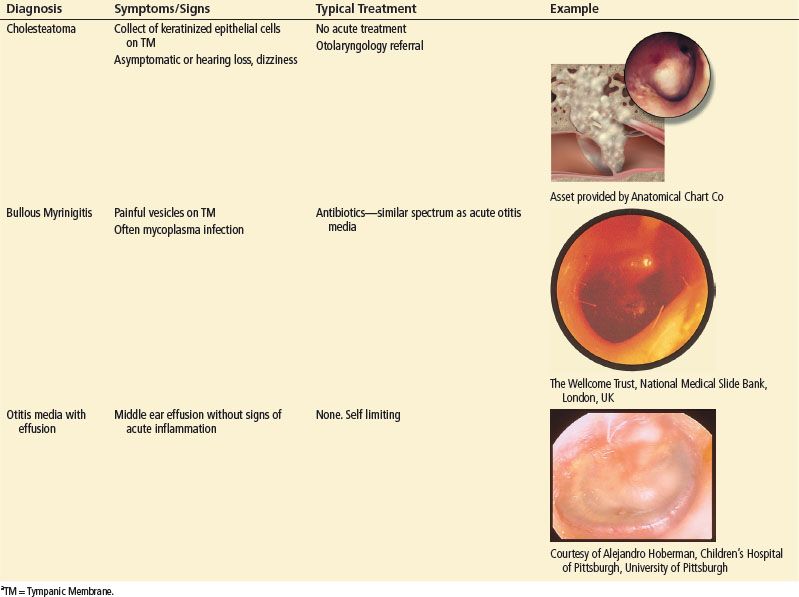 Acute Otitis Media Vs Otitis Media With Effusion