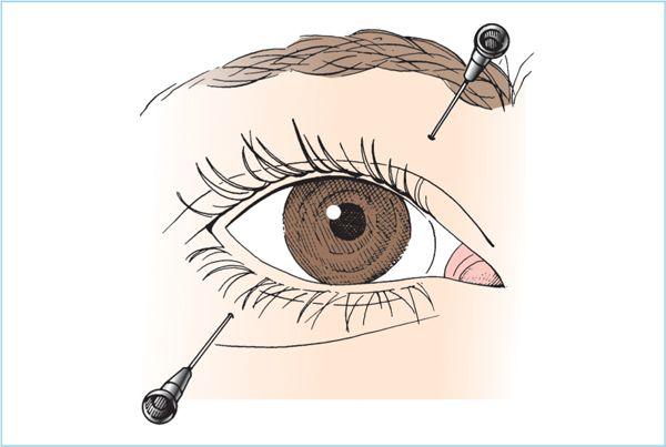 Ophthalmic Anesthesia | Anesthesia Key