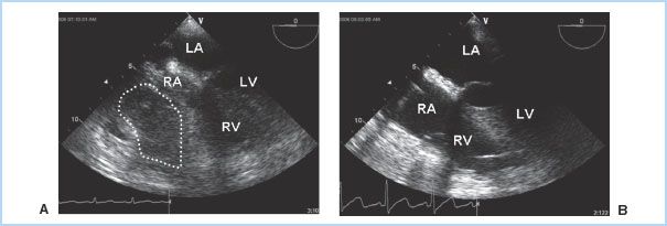 Anesthetic Considerations For Patients With Pericardial - 