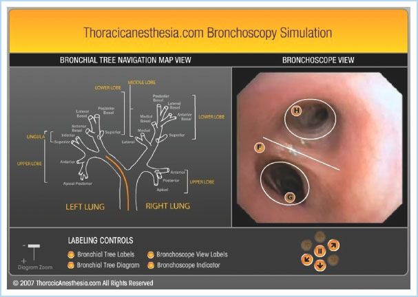 Anesthetic Management for Surgery of the Lungs and Mediastinum