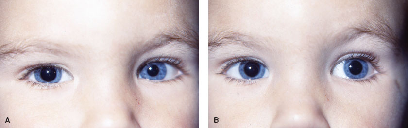 unequal pupil size with dysfunction