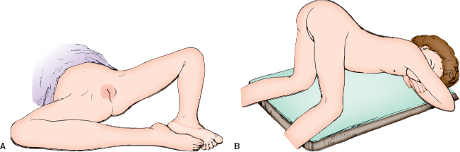 frog leg position examination