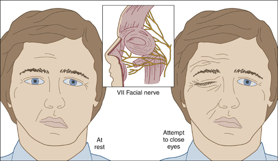 idiopathic-facial-paralysis-bell-s-palsy-anesthesia-key