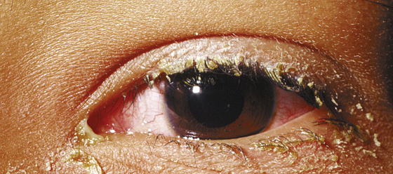 Bacterial Conjunctivitis Pink Eye 