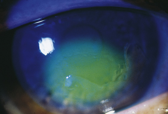 scleral abrasion fluorescein