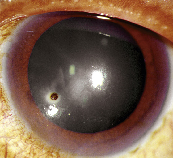 corneal rust ring