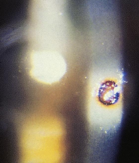 corneal rust ring