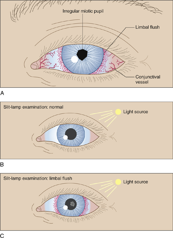 Iritis (Acute Anterior Uveitis) | Anesthesia Key