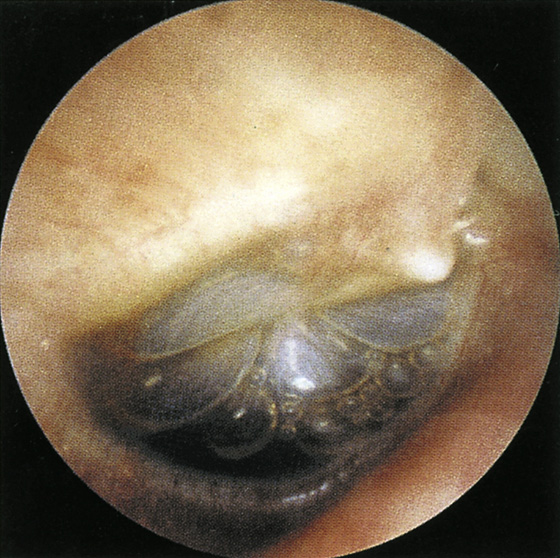 fluid behind eardrum