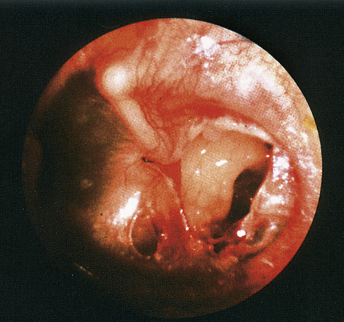 ruptured tympanic membrane