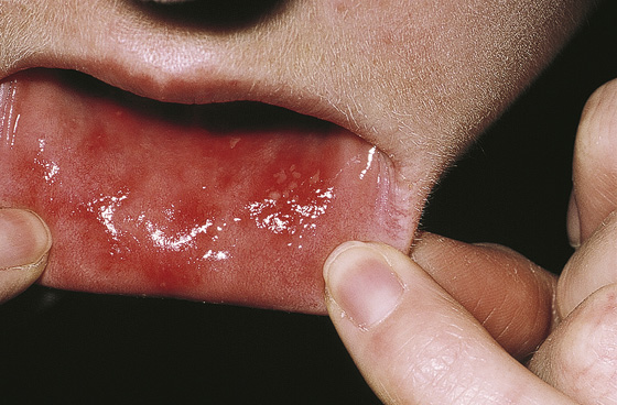 aphthous stomatitis tongue