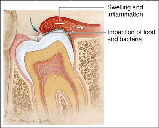 pericoronitis infection