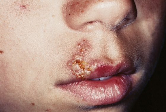 mild herpes lips