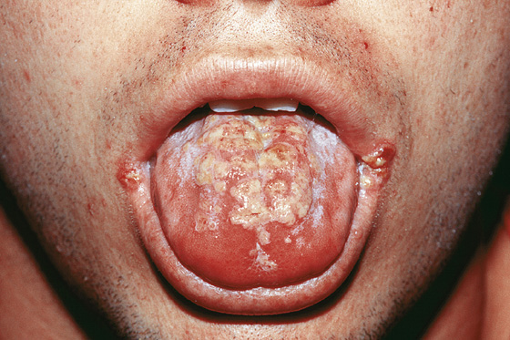 herpes 2 in the mouth