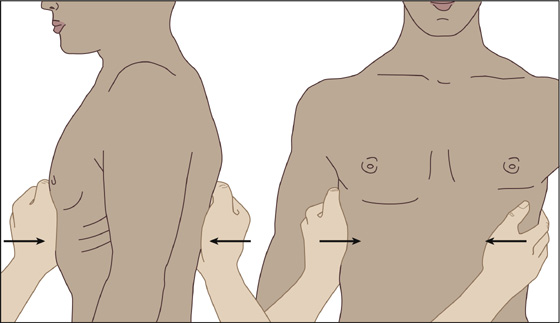 costochondral joint separation