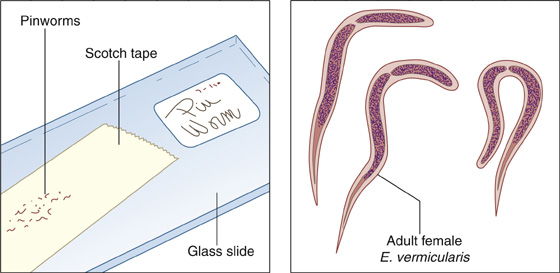 Enterobiasis Pinworm Threadworm Seatworm Anesthesia Key