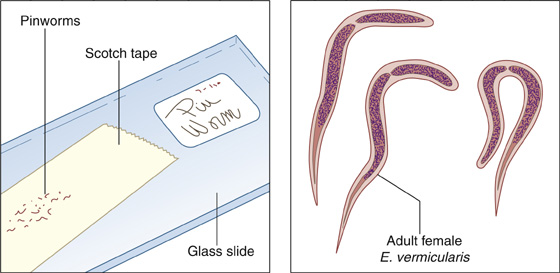 Krónikus pinworm betegség, Pinworms krónikus formája Pinworm okoz - Krónikus pinworm