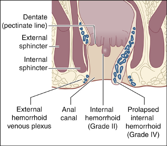 prolapsed hemorrhoid vs external