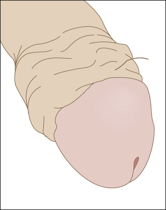 Tinea Pedis, Tinea Cruris, Tinea Corporis (Athlete's Foot, Jock