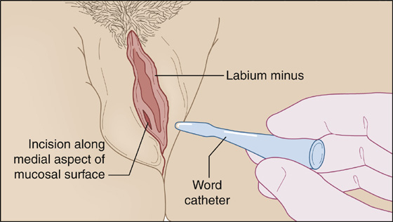 Bartholin's cyst and abscess treatment - GYNECOLOGY