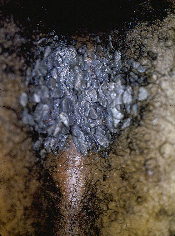 vaginal warts