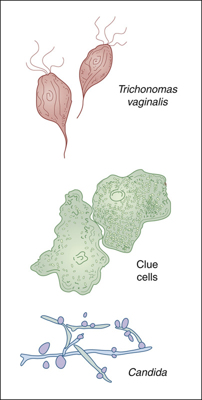trichomonads and clue cells