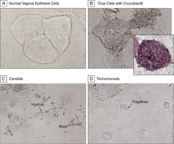 trichomonads and clue cells