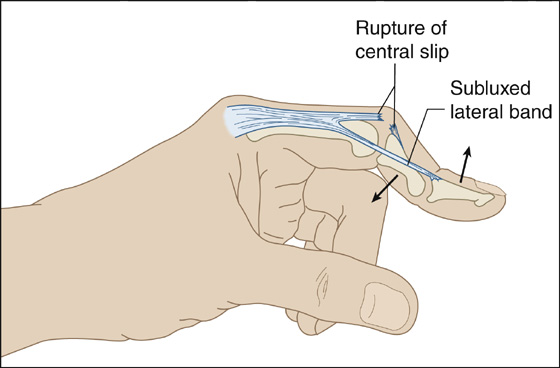 Boutonni re Finger Anesthesia Key