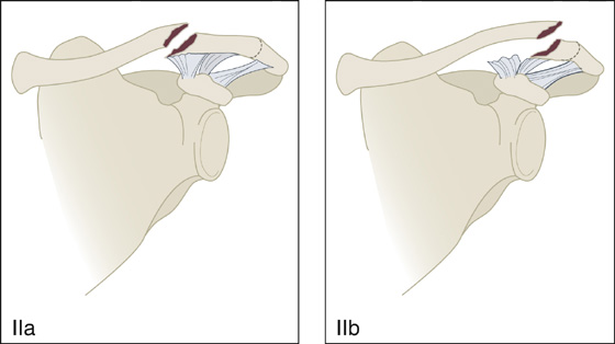 distal clavicle fracture