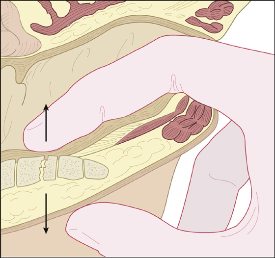 dislocation of coccyx rectal