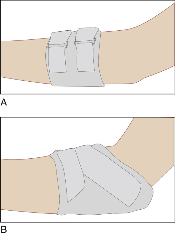 Tinea Pedis, Tinea Cruris, Tinea Corporis (Athlete's Foot, Jock