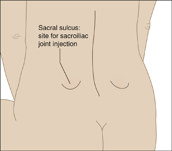 Injury Edition: Low Back Sprain – EasyFlexibility