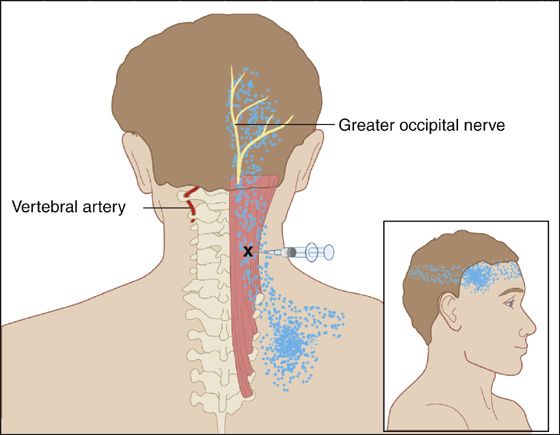 Better Understanding Myofascial Pain – Consult QD