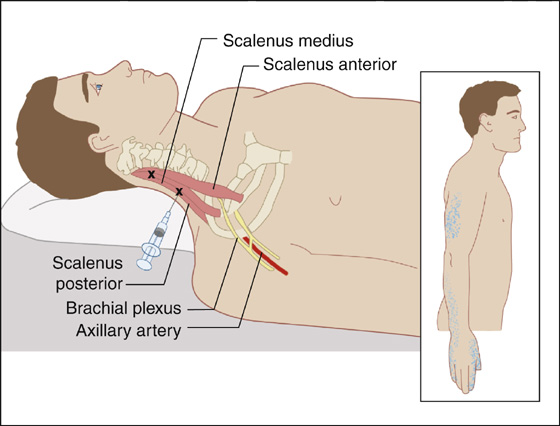 serratus posterior trigger point