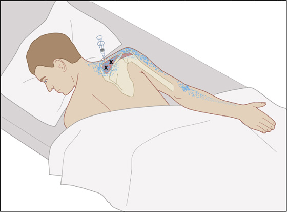 supraspinatus trigger points