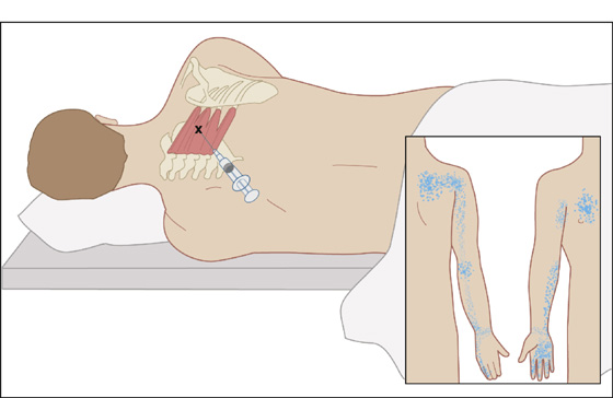 serratus posterior trigger point