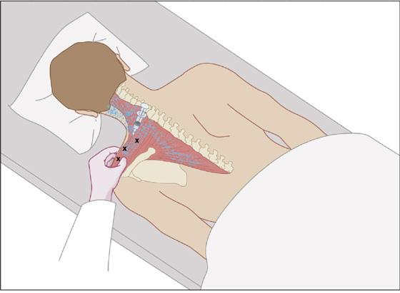 Better Understanding Myofascial Pain – Consult QD