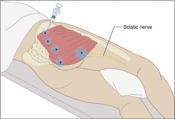 Myofascial Pain Syndrome, Fibromyalgia (Trigger Points)