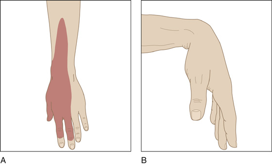 radial nerve wrist