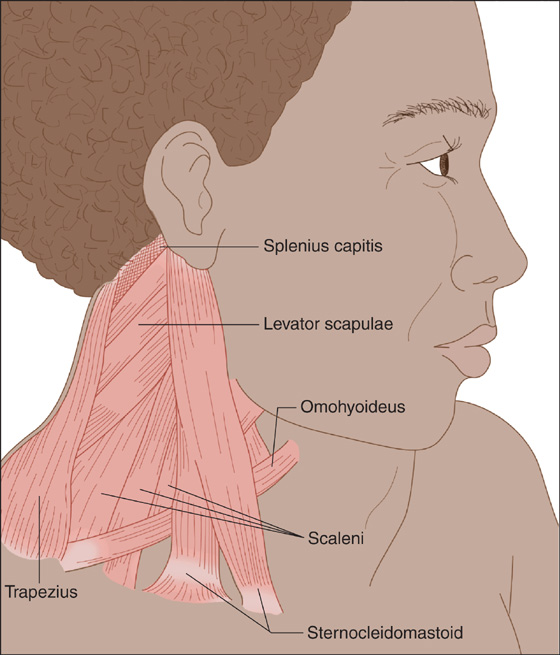 torticollis in adults