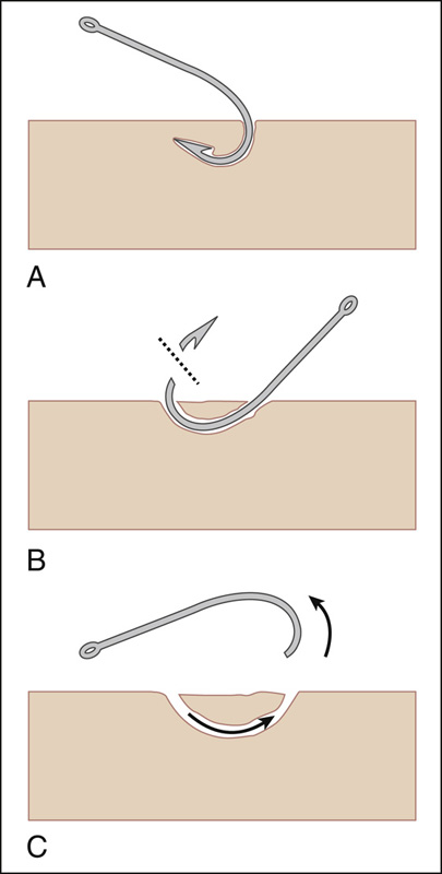 Fishhook Removal