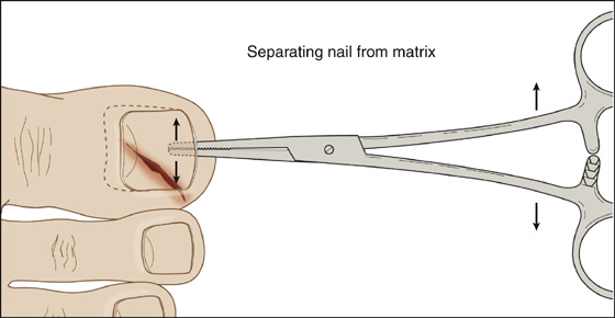 Nail Bed Laceration | Anesthesia Key