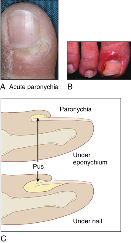 How to Treat an Infected Ingrown Toenail - MVS Podiatry Associates